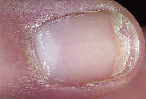 Dry, brittle nails that frequently crack or split have been linked to