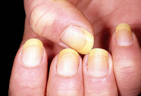 One of the most common causes of yellow nails is a fungal infection